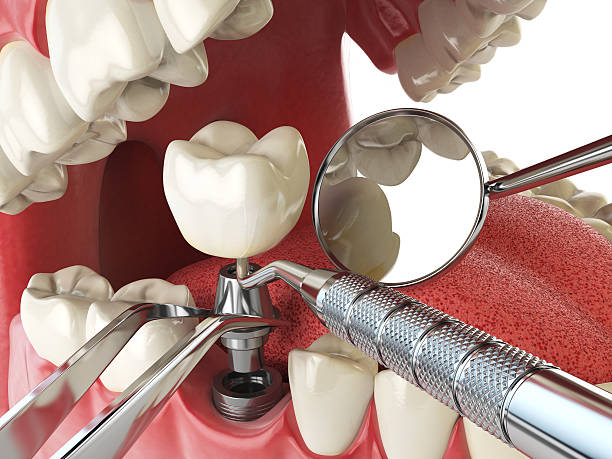 Best Broken or Cracked Tooth Emergency Dentist in Hollywood, SC